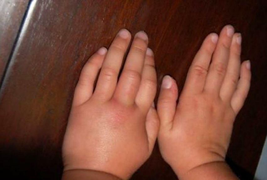 یک پرسش مهم برای سلامتی، چرا دستها ورم میکنند؟